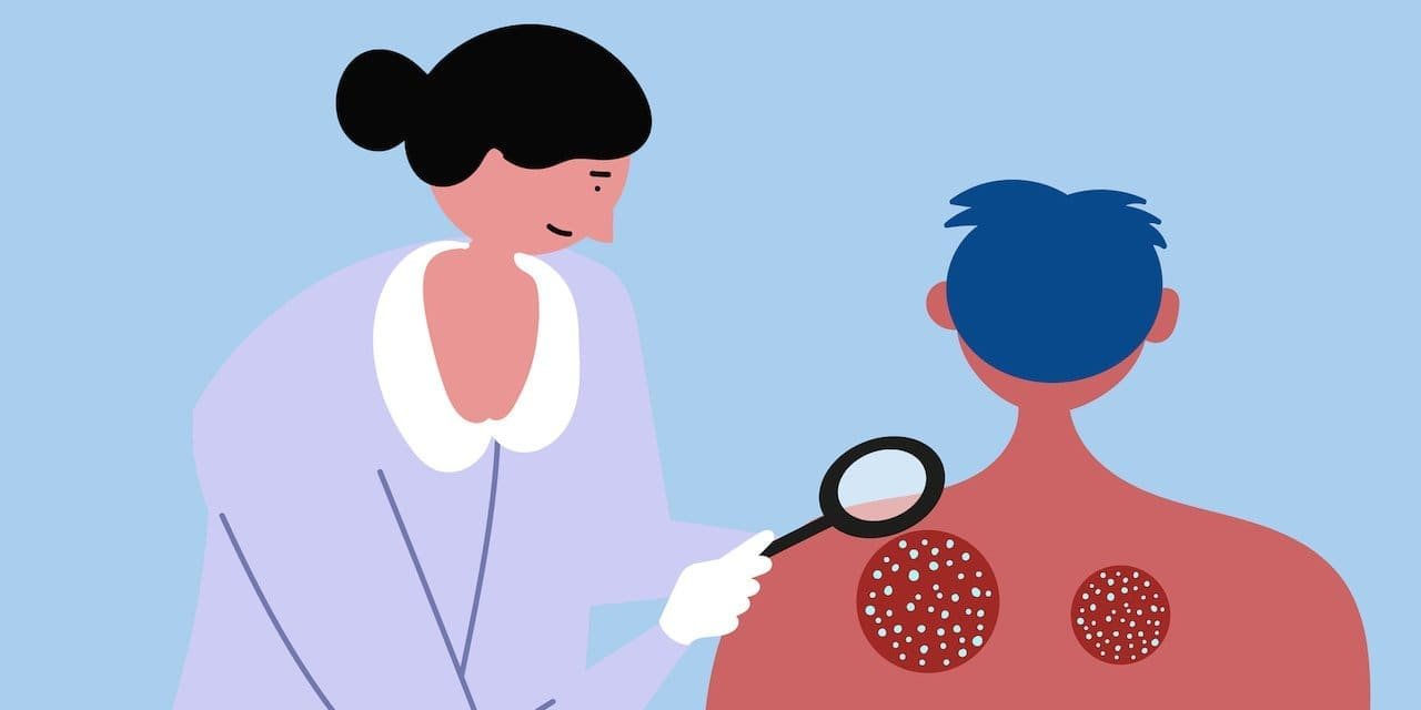 Dermatologists Highlight Skin Rash as Potential COVID-19 Symptom